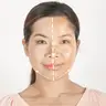 Mesotherapie gegen Pigmentflecken