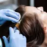Мезотерапія волосяноі частини голови