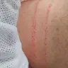 Бланшинг Belotero soft, balance