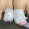 ВРОСЛИЙ НІГОТЬ без запалення