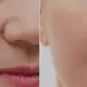 Microneedeling Behandlung der Nasolabialfalten