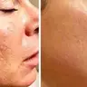 Microneedeling Narbenkorrekturen