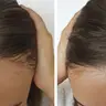 Microneedeling Haarausfallbehandlung