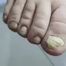 Педикюр Подологічний ускладнений.
