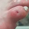 Видалення мозоля