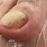 Зачистка оніхолізісу
