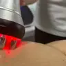 RF-ліфтинг двох зон