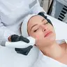 Лазерна епіляція
