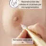 Reconstruction d’aréoles mammaires en 3D