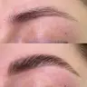 Brow Lifting