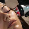 Radiofrequência Facial