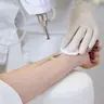 Remoção de Tatuagem