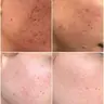 PEELING ANTIACNE