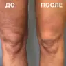 SMAS LIFTING-Підтяжка колін.