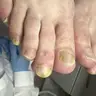 Обробка грибка нігтів