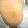 Обробка бородавок