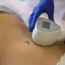 RF-LFTING На апараті-BTL EXILIS ELITE-Живіт.