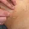Голкотерапія