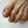 Оніхолізіс