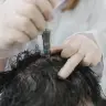Microneedling gegen Haarausfall