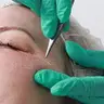 Collagen Lift (Faden Lifting)