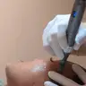 Microneedling