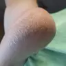 Pedicura Durezas