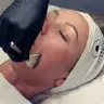 Fruchtsäurepeeling - Zellerneuerung