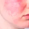 Rosacea & Empfindliche Haut