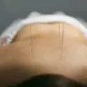 Голкотерапія