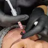 Ботулінотерапія