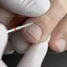 Лікування разом з дерматологом