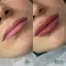 Контурна пластика вуст