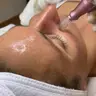 Microneedling Behandlung