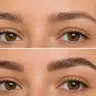Brow Lifting