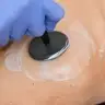 Diatermia