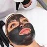 Peeling a Carbono ND-YAG