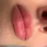 Nachbehandlung (ab der 2. bis zur 5. Woche) Lippen