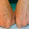 Rejuvenescimento Mãos ( IPL)