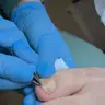 ВРОСЛИЙ НІГОТЬ без запалення