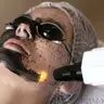 Gesicht + Dekolleté Carbon-Peeling