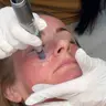 Microneedling Gesicht und Hals