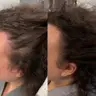 Microneedling Kopf