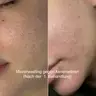 Microneedling bei Aknenarben, Dehnungsstreifen und Narben
