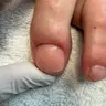 Nagelprothetik
