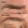 PhiRemoval (Permanent Make-Up Entfernung)
