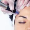 Microneedling