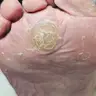 Первинна Видалення Мозолі суха