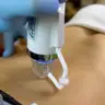 Мікроголковий RF-ліфтинг живота