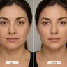 Ботулінотерапія Full Face (все обличчя)